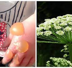 Parents warned of toxic plant that can cause blistering skin burns - Netmums