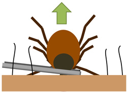 Photo of how to remove a tick safely
